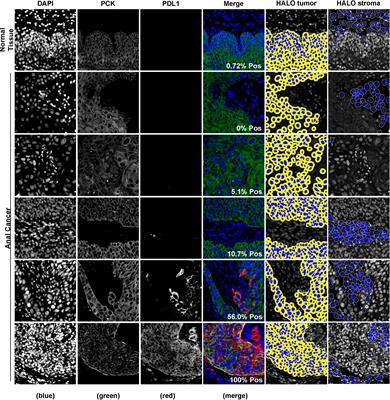 The prognostic impact of PD-L1 and CD8 expression in anal cancer patients treated with chemoradiotherapy